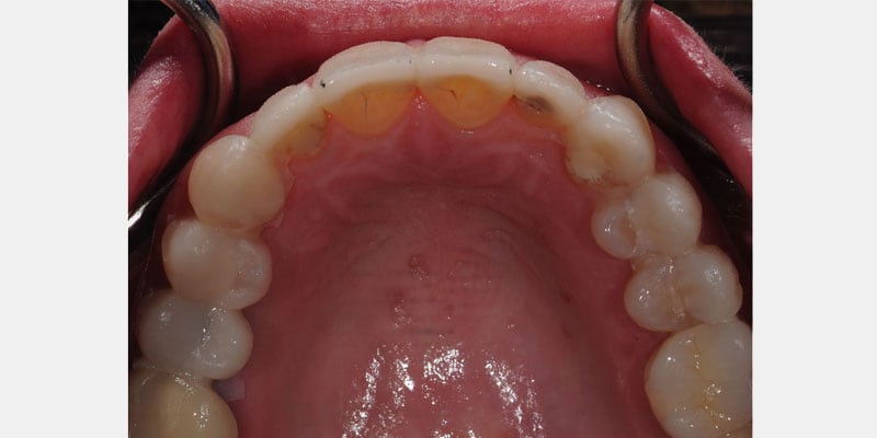 Carillas dentales: las señales de alerta que muchos dejan pasar hasta que es tarde